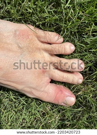 Fire ant bites on a foot
