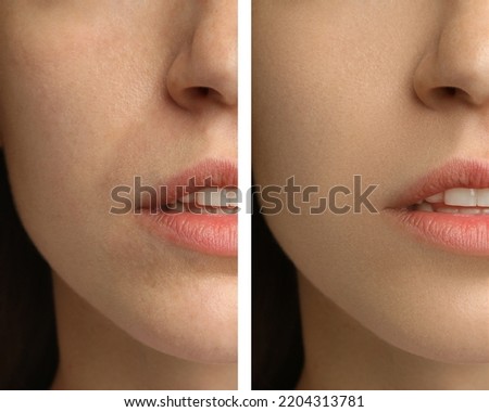 Collage with photos of woman having dry skin problem before and after moisturizing, closeup Royalty-Free Stock Photo #2204313781