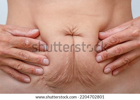 Cropped woman hands on belly pressed skin to show sagging skin after diet and stretch marks after pregnancy Royalty-Free Stock Photo #2204702801