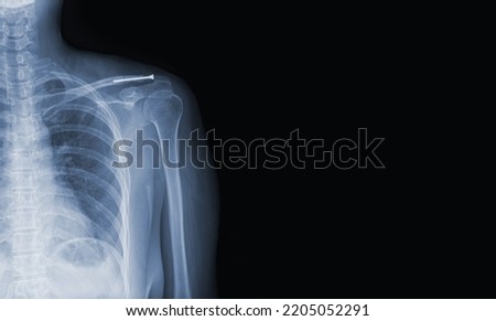 x-ray images of the shoulder joint modified coracoclavicular stabilizer to see injuries bones and tendons for a medical diagnosis.Medical image concept and copy space. Royalty-Free Stock Photo #2205052291