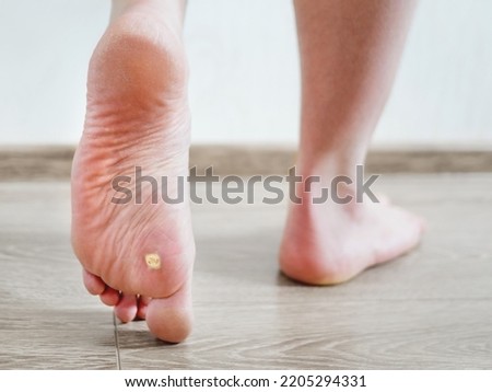 Close up photo of plantar wart on man's foot. Verruca plantaris on the heel. Royalty-Free Stock Photo #2205294331