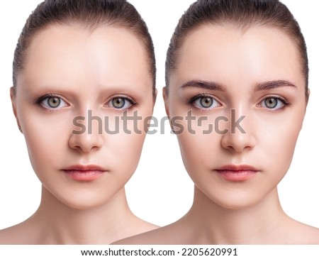 Young woman with bald eyebrows before and after hair transplantation. Alopecia concept. Royalty-Free Stock Photo #2205620991