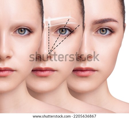 Young woman with bald eyebrows before and after hair transplantation. by steps Royalty-Free Stock Photo #2205636867