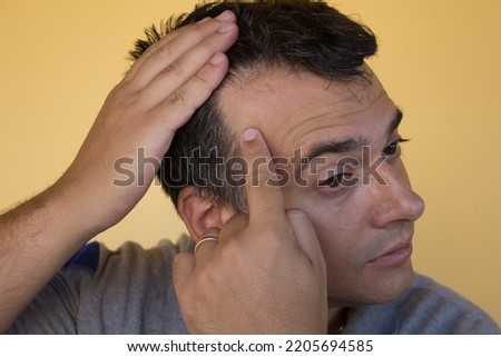 Image of a man showing the onset of hair loss and the principle of receding hairline. Possible causes and remedies for hair loss
 Royalty-Free Stock Photo #2205694585