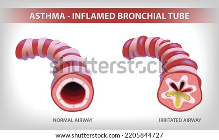 The illustration shows two parts of the bronchi, one normal and the other bronchitis and filled with sputum. use in medical and educational Royalty-Free Stock Photo #2205844727