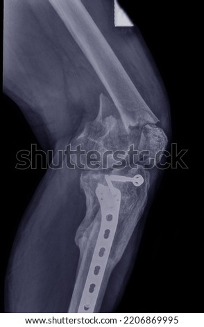 X-ray photograph of male knee fracture in traffic accident