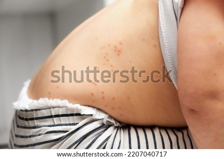 Back of Small Child with Red Rash. Baby with Red Spots Blisters on the skin. Close up of Painful Rash. Health Problem. Rubella, Chickenpox, Scarlet fever, Measles. Bacterial Infections, Disease. Mpox Royalty-Free Stock Photo #2207040717
