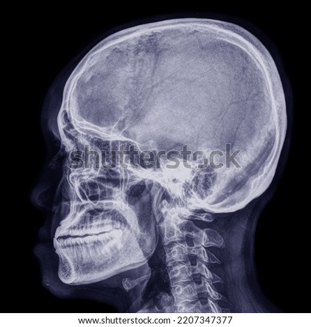 x-ray photo An old man's skull in perfect condition.