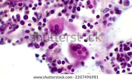 Osteoclasts. Two osteoclasts in red bone marrow. The osteoclast is a large multinucleated cell which shows a ruffled border at a site of active bone resorption.  H end E stain.	 Royalty-Free Stock Photo #2207496981
