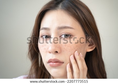 young female have freckles on her face. Royalty-Free Stock Photo #2207773515