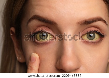 Woman checking her health condition, closeup. Yellow eyes as symptom of problems with liver Royalty-Free Stock Photo #2209463889