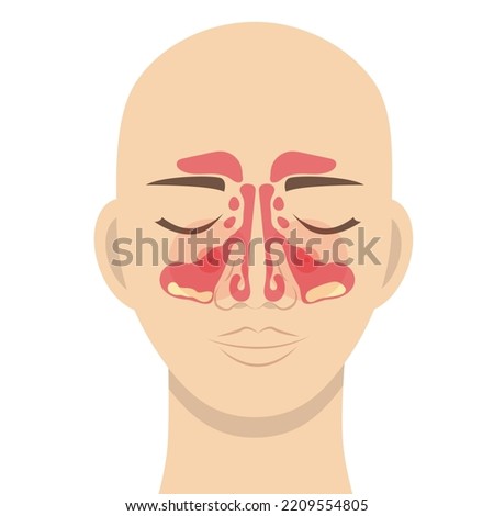 A human head with a schematic image of the maxillary sinuses, inflammation and accumulation of pus in the maxillary sinuses with sinusitis Royalty-Free Stock Photo #2209554805
