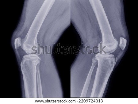 x-ray photo Comparison of left knee and right knee in terms of medical treatment