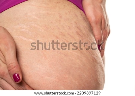 Close-up of a female thigh with white and dark stretch marks from a sharp weight loss or weight gain isolated on a white studio background