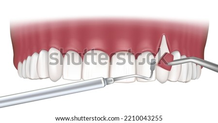 Gum Recession Treatments. Soft tissue graft surgery in the gum. Illustration of Dental concept. Periodontal Disease Royalty-Free Stock Photo #2210043255