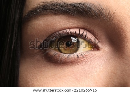 Woman with yellow eyes as background, closeup. Liver problems symptom Royalty-Free Stock Photo #2210265915