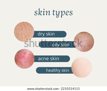 skin types, Skin Problems, Acne,oily, Dry  andhealthy Royalty-Free Stock Photo #2210314115
