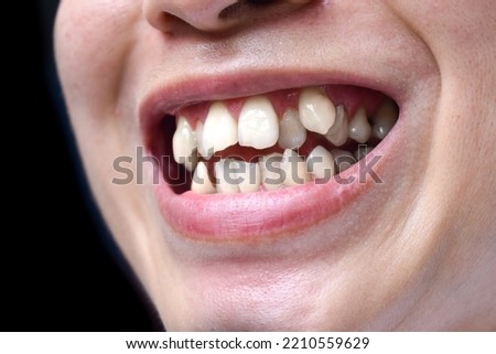 Stacked or overlapping white teeth of Asian man. Also called crowded teeth. Royalty-Free Stock Photo #2210559629