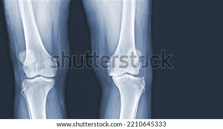 Film x-ray of human knee Osteoarthritis of the Knee normal ligaments Medical image concept. Royalty-Free Stock Photo #2210645333