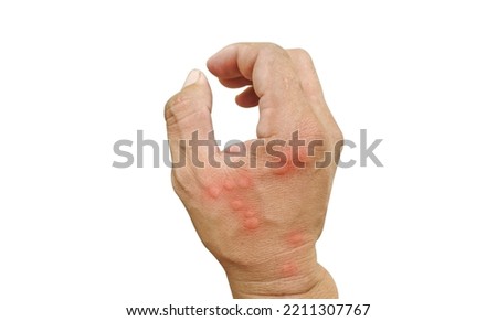 Close-up Hand bee stinging hand insects worker skin allergy, allergic treatment by a honey bee, wildlife, wild nature, forest, Medical image concept.on white background.