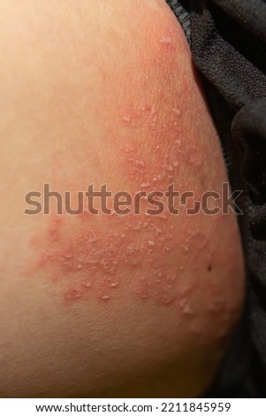 Tinea Cruris, Ring Worm infection on skin, Itching in the groin