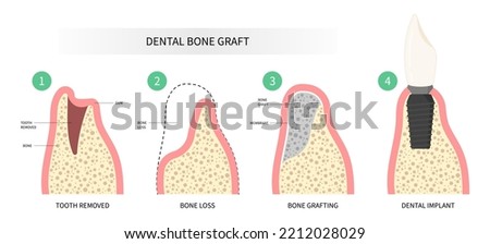 Dental surgery for oral teeth implant with bone graft procedure Royalty-Free Stock Photo #2212028029