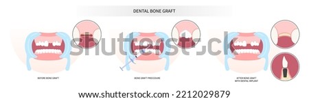 surgery of oral teeth bone graft procedure Royalty-Free Stock Photo #2212029879