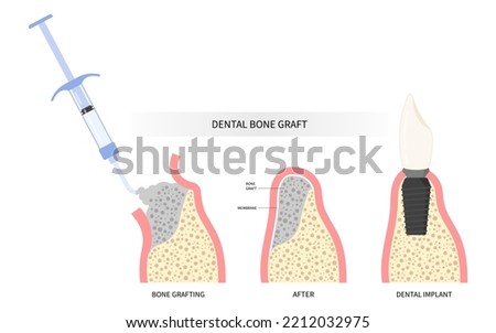 Procedure of Teeth bone Graft surgery Royalty-Free Stock Photo #2212032975