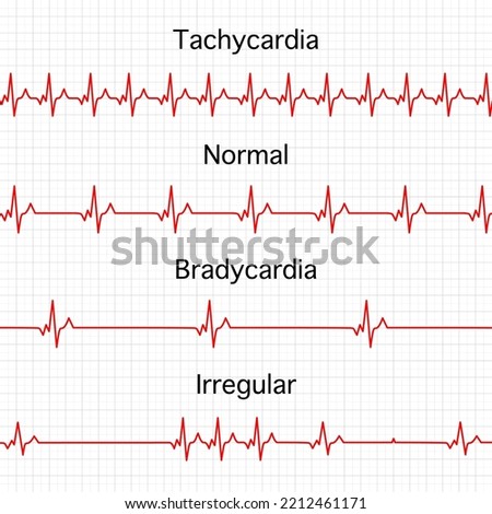 Heart rate graphics. Vector illustration. Electrocardiogram. illustration of medical electrocardiogram - ECG on chart paper. Tachycardia, normal, Bradycardia, Irregular heart beat. Royalty-Free Stock Photo #2212461171