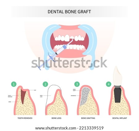 extraction Procedure of Teeth bone Graft surgery Royalty-Free Stock Photo #2213339519