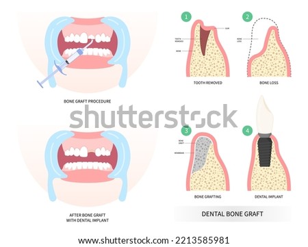 Implant of Teeth bone Graft surgery Royalty-Free Stock Photo #2213585981