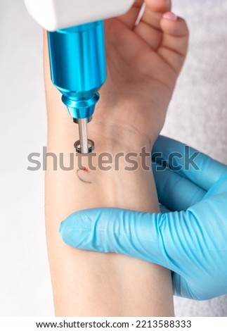 The doctor makes the procedure for laser tattoo removal on the girl's arm. Royalty-Free Stock Photo #2213588333