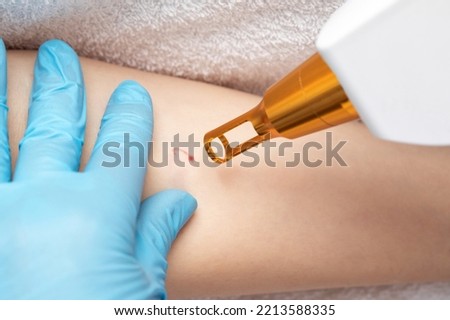 The doctor makes the procedure for laser tattoo removal on the girl's arm. Royalty-Free Stock Photo #2213588335