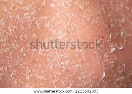 Sunburn, close-up of human skin. Flaky skin from allergies, peeling or eczema. Dry skin in need of treatment and hydration. Royalty-Free Stock Photo #2213602303