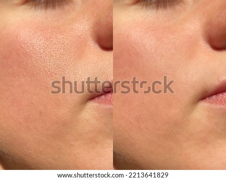 Compare before and after (retouch photo) of close up wide large pores skin on oily face have pimple. Effect after use cream or treatment for facial care face skin to better