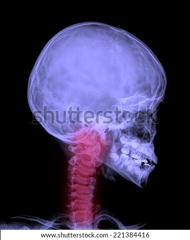 x ray Image of child head