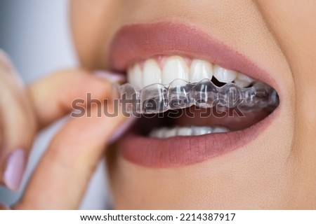 Clear Aligner Dental Night Guard For Teeth Royalty-Free Stock Photo #2214387917