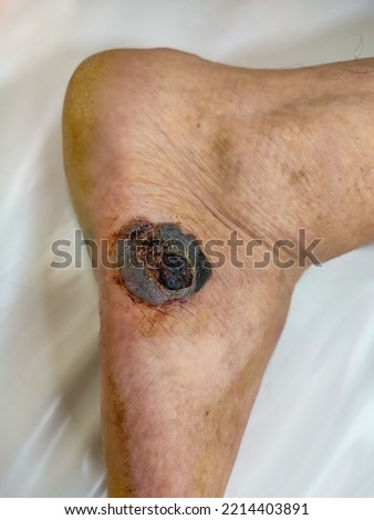 Melanoma of the skin of the foot is a malignant tumor of the human skin Royalty-Free Stock Photo #2214403891