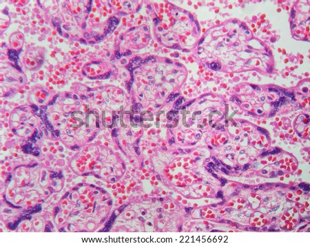 This micrograph of placental tissue shows syncretial knotting, a bunching of cytoplasm and nuclei resulting from preeclampsia, a serious complication of late pregnancy.  Magnification 400x 			