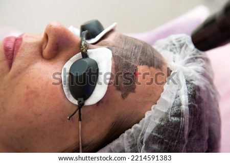 Portrait an adult woman lying with her eyes closed during carbon peeling procedure.