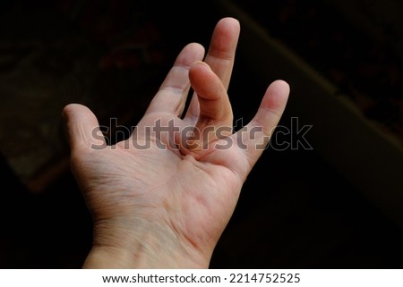Hand of a person with Dupuytren's contracture, which does not allow to bend the finger Royalty-Free Stock Photo #2214752525