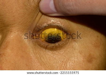 Deep jaundice in Asian male patient. Yellowish discoloration of skin and sclera. Hyperbilirubinemia. Acute hepatitis. Royalty-Free Stock Photo #2215155975