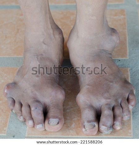 foot of gout patient Royalty-Free Stock Photo #221588206
