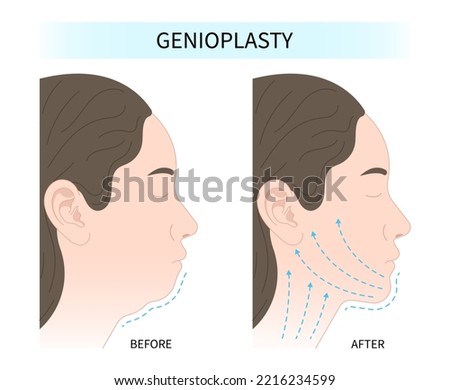 facial reshaping contour and rhytidectomy Orthodontist Temporomandibular joint Orthodontic double long Dermal chin augmentation nose grafting Royalty-Free Stock Photo #2216234599