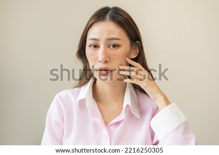 Dermatology, expression face worry, stressed asian young woman hand touching facial at dark spot of melasma, freckles from pigment melanin, allergy sun. Beauty care, skin problem treatment, skincare. Royalty-Free Stock Photo #2216250305