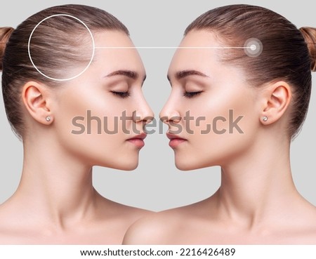 Young woman before and after hair treatment. Hair loss problem concept. Royalty-Free Stock Photo #2216426489