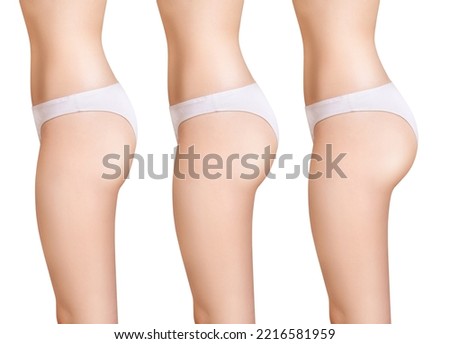 Female buttocks before and after augmentation. Isolated on white background. Royalty-Free Stock Photo #2216581959