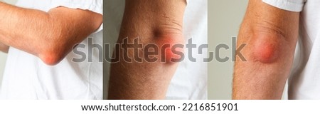 Man swelling erythematous lump pain elbow from Olecranon bursitis, student elbow medical condition. Inflammation of the bursa located under the elbow Olecranon trauma or repetitive smaller traumas. 