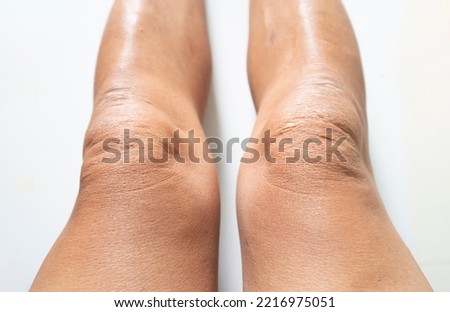 The skin on a person's legs and knees is dry and rough. Royalty-Free Stock Photo #2216975051