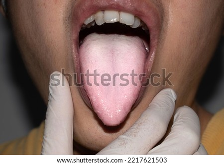 Coated tongue or white tongue of Asian, Chinese man. It appears with white layer when debris, bacteria and dead cells become lodged between enlarged papillae. Loss of taste called ageusia. Royalty-Free Stock Photo #2217621503